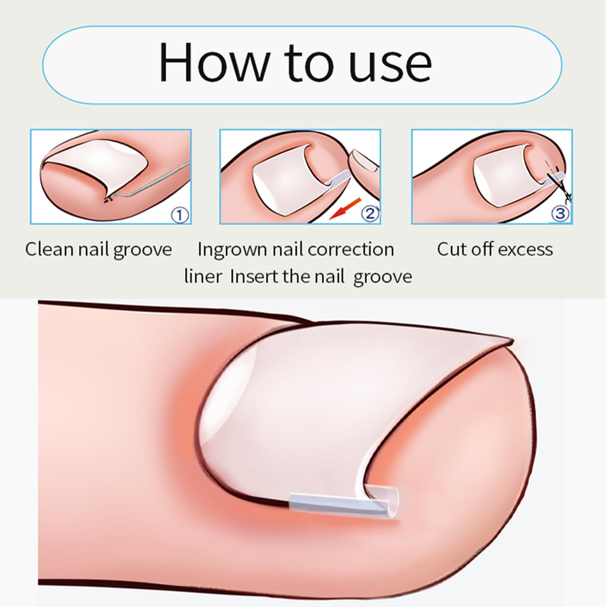 Professional Ingrown Toenail Toolkit with Breathable Ingrown Toenail Strips, Curved Toenails Corrector Patch, Painless File and Lifter for Home Pedicure Care ( box damaged)