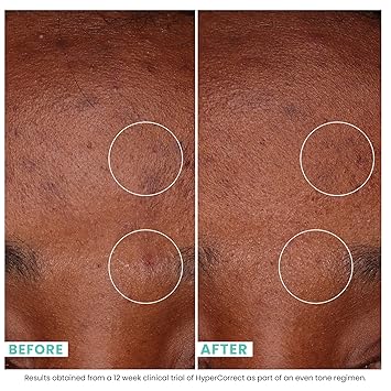 Urban Skin Rx HyperCorrect Fading Cream 5 Cysteamine 1 Niacinamide For Scars Uneven Skin Tone, 1.7 fl oz