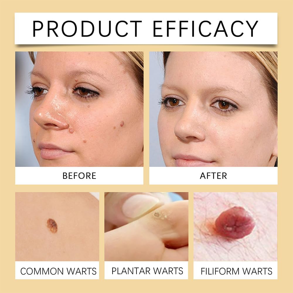 Wart Remover?Bee Venom Cream?Natural Ingredients Smooth and Moisturize The Skin Suitable for All Skin Types ( 20g )