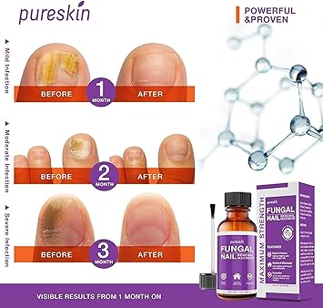 Toenail Fungus Revitalizer for Toenail  Fingernail: Advanced  Effective Formula
