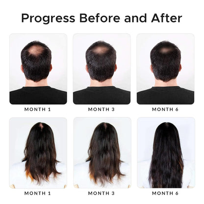 Minoxidil & Biotin Shampoo for Hair Growth - Enriched with Caffeine, Castor Oil & Onion - DHT Blocker for Thicker, Healthier Hair - Strengthening Formula for Men & Women
