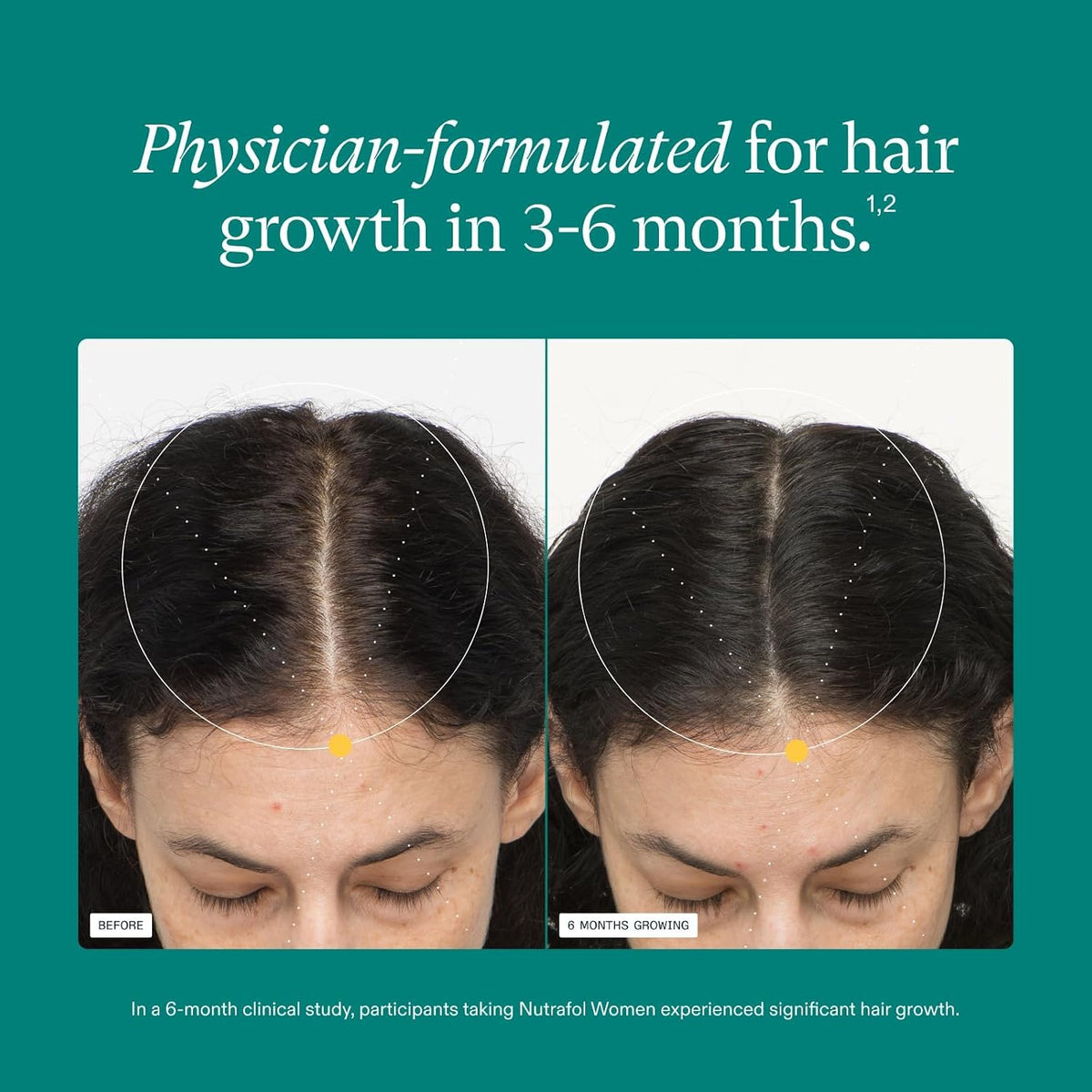 Nutrafol Women's Hair Growth Supplements, Ages 18-44, Clinically Tested for Visibly Thicker and Stronger Hair, Dermatologist Recommended - 1 Month Suppl