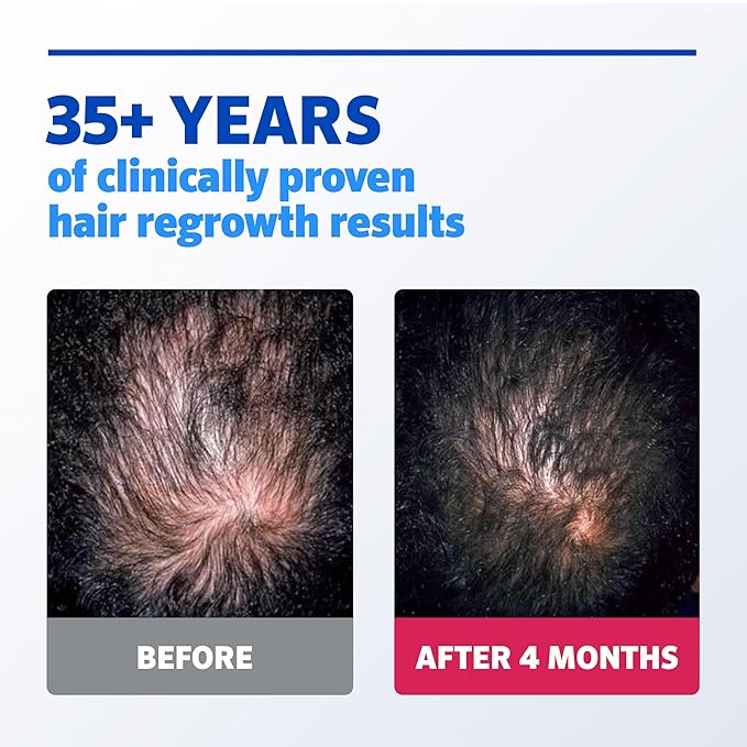 Men's Rogaine Extra Strength 5 Minoxidil Topical Solution for Thin Hair, Hair Loss Treatment to Regrow Fuller, Thicker Hair, 3 Month Supply, 3 Bottles