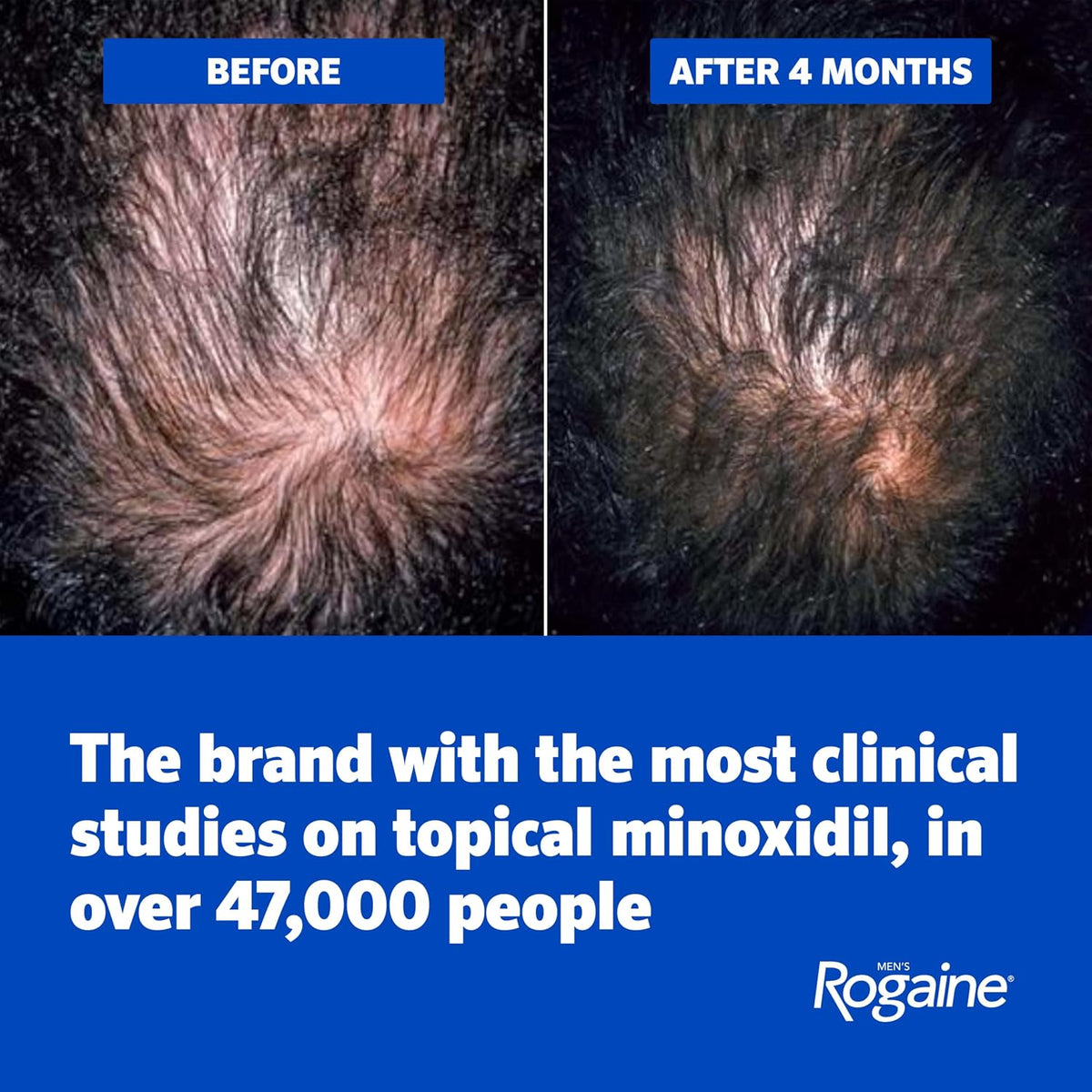 Men’s Rogaine 5% Minoxidil for Men Foam, Clinically Proven Regrowth for Thinning Hair, Topical Hair Loss Treatment, Unscented Topical Aerosol, Results in 8–16 Weeks, 3-Month Supply, 3 x 2.11 oz