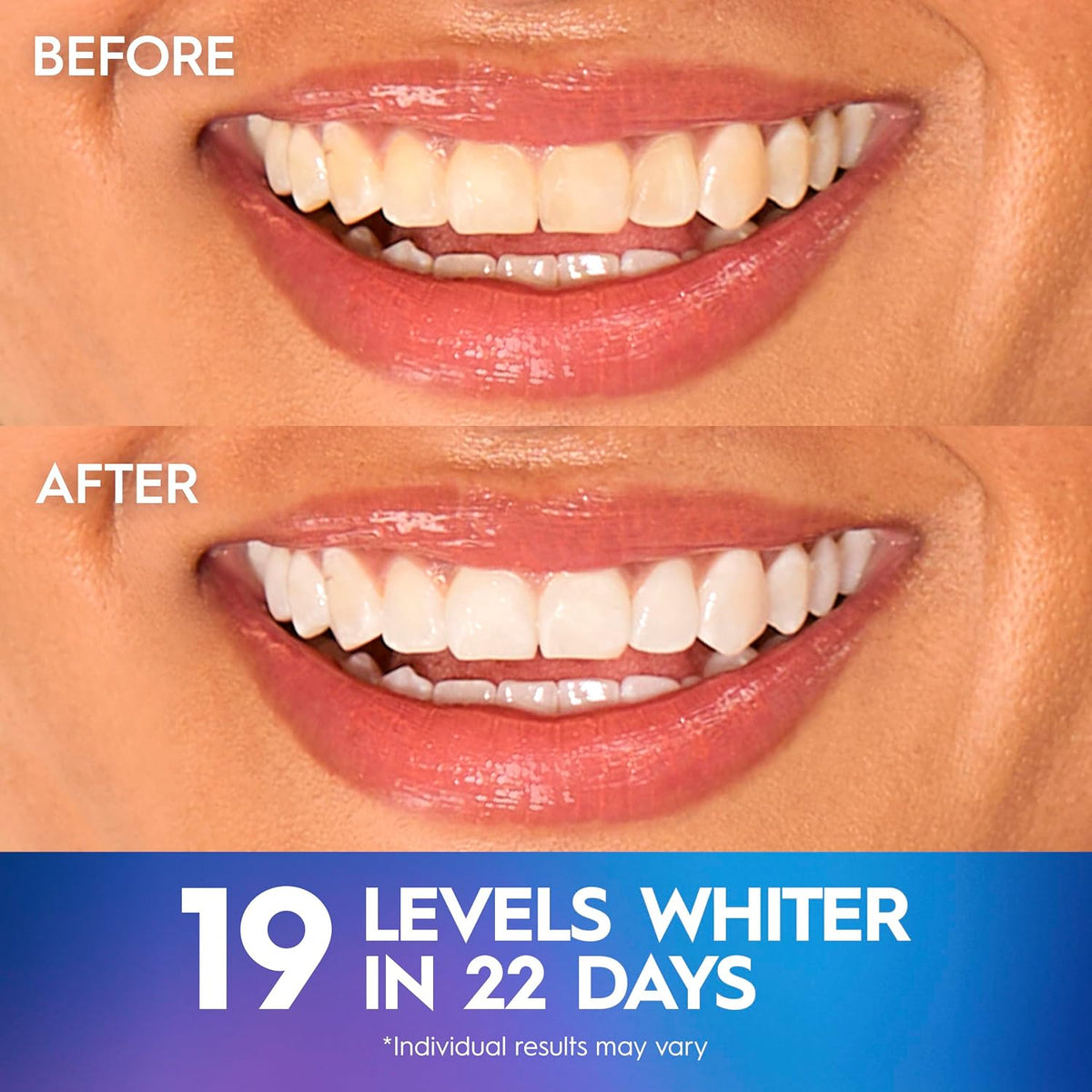 Crest 3D Whitestrips Professional Effects – Teeth Whitening Kit, 22 Treatments in 22days (20 + 2 Bonus), Each with 1 Upper/1Lower, 44 Strips – Crest 3DWhite Teeth Whitening Strips ( Little different picture, Box Damaged )